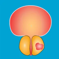 Nyushko prostate nomograms